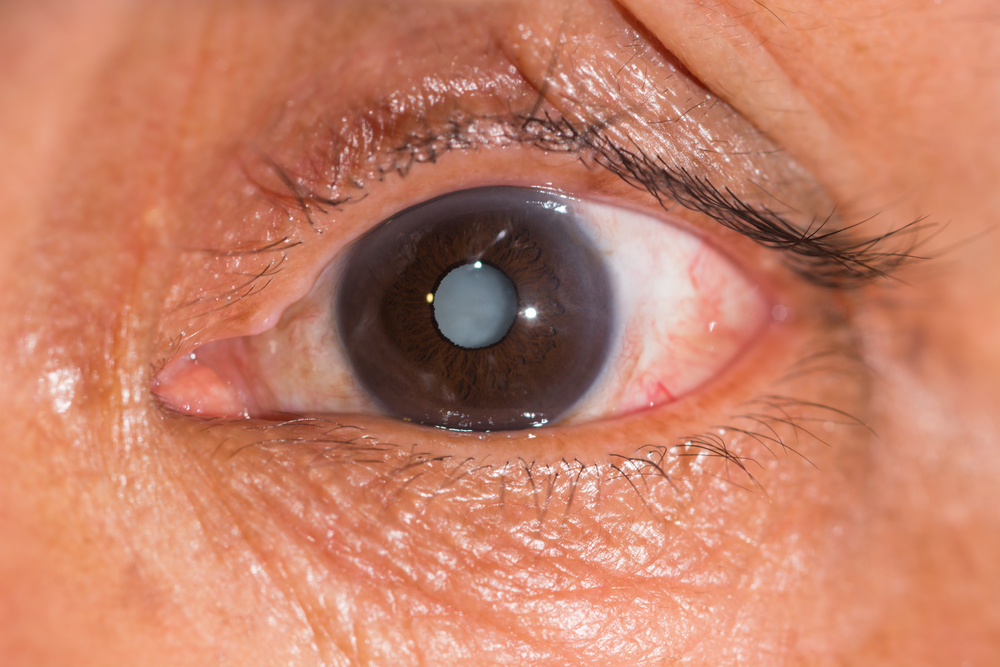Cataracts Symptoms