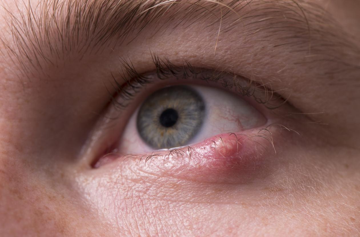 Inflammation of the eyelids